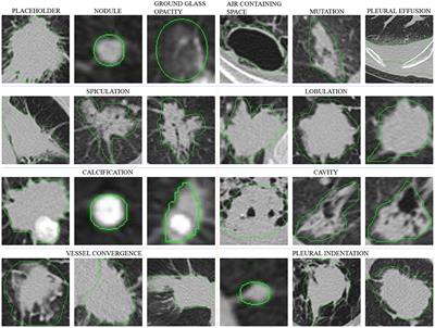 A Dataset of Pulmonary Lesions With Multiple-Level Attributes and Fine Contours